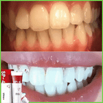 Load image into Gallery viewer, Dentifrice blanchissant probiotique Gestion de la santé bucco-dentaire(Élimine des années de taches)
