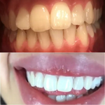 Load image into Gallery viewer, Dentifrice blanchissant probiotique Gestion de la santé bucco-dentaire(Élimine des années de taches)
